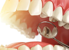 Фото Услуги стоматологии: Лечение кариеса Фото Услуги стоматологии: Лечение кариеса.