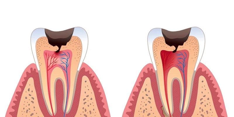 Фото Услуги стоматологии: Лечение пульпита Фото Услуги стоматологии: Лечение пульпита.