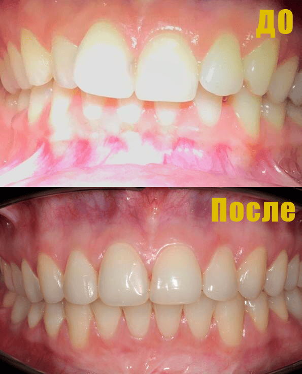 Фото Исправление глубокого прикуса Фото Исправление глубокого прикуса.