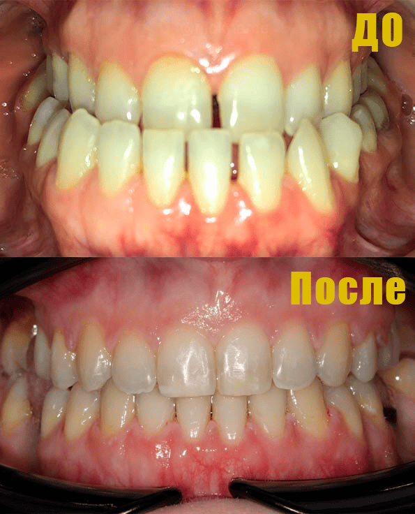 Фото Исправление мезиального прикуса Фото Исправление мезиального прикуса.