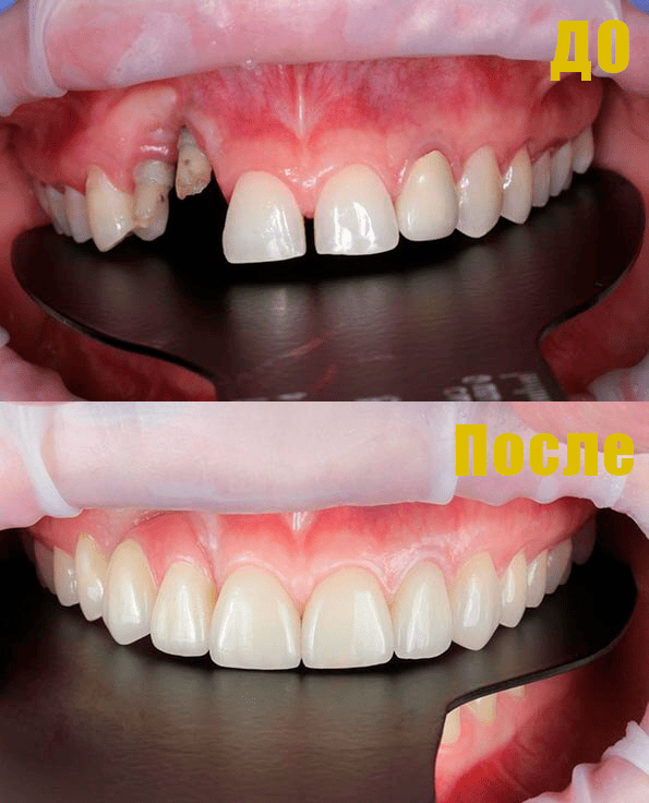 Фото Восстановление верхнего зубного ряда Фото Восстановление верхнего зубного ряда.