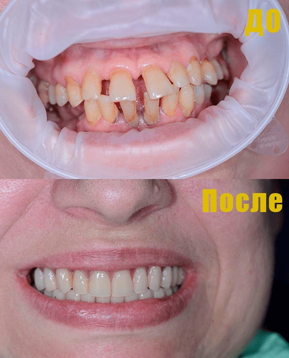 Фото Имплантация зубов All-on-4 Фото Имплантация зубов All-on-4.