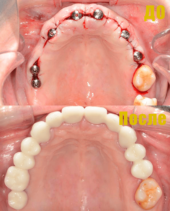 Фото Установка имплантов Фото Установка имплантов.