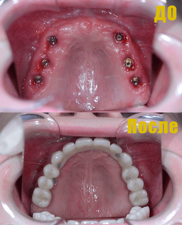 Фото Установка имплантов All-on-6 Фото Установка имплантов All-on-6.